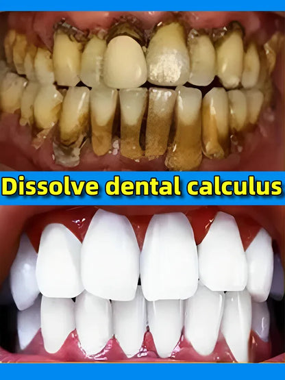 remover dental calculus whitening teeth mouth odor removal bad breath Preventing Periodontitis [DEN]