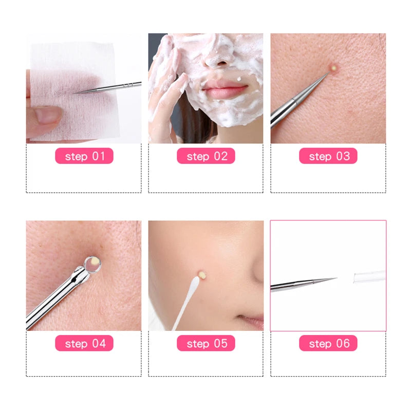 1 Pcs Blackhead Comedone Acne Pimple Blemish Extractor Remover Stainless Steel Needles Remove Tools Face Skin Care Pore Cleaner [SKC]