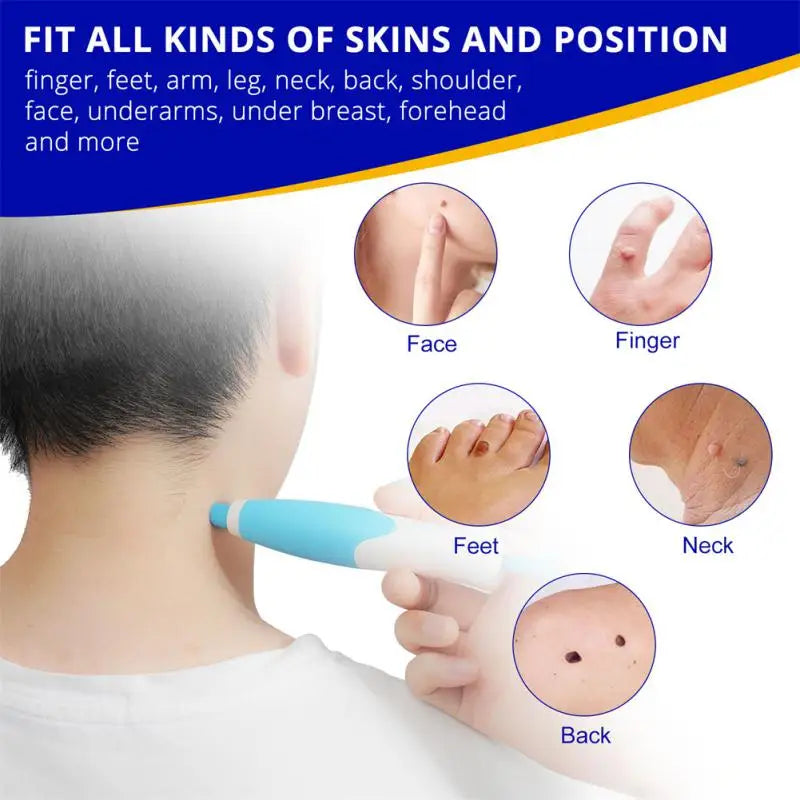 2 In1 Painless Auto Skin Tag Mole Wart Removal Kit Cleaning Tools Face Skin Care Body Wart Dot Treatments Remover Beauty Health [SKC]