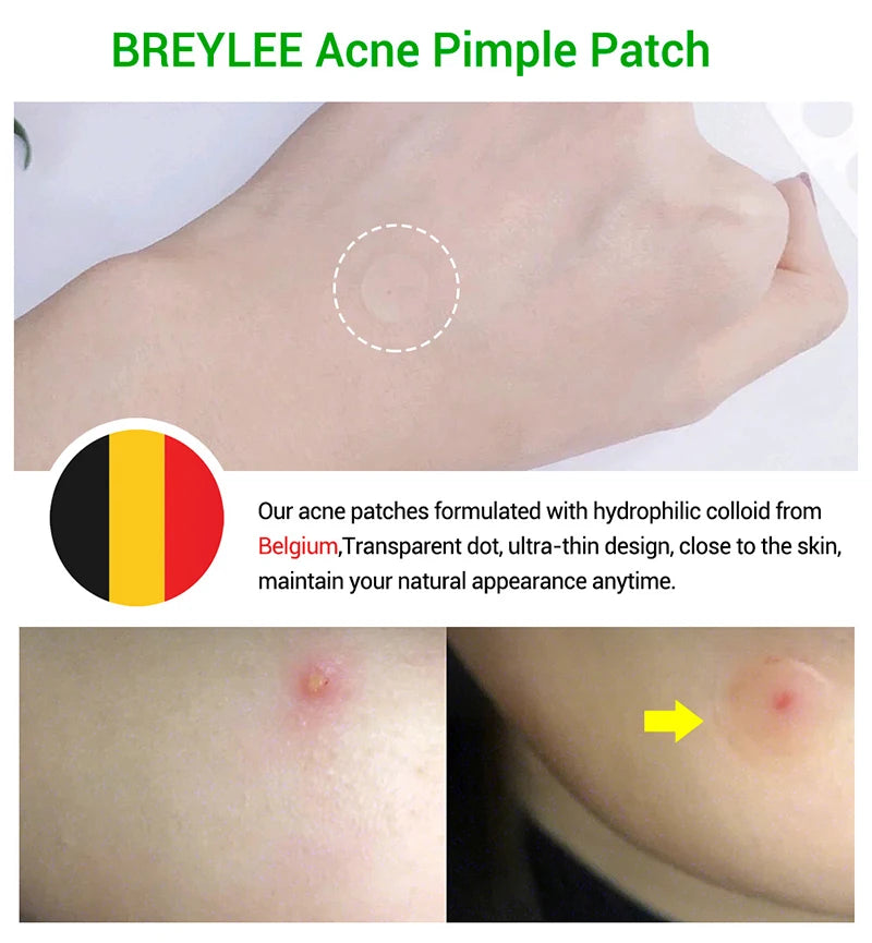 0.1mm Acne Pimple Patch Stickers Waterproof Acne Treatment Pimple Remover Tool Blemish Spot Facial Mask Skin Care 22 patches/bag [SKC]