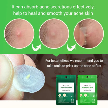 0.1mm Acne Pimple Patch Stickers Waterproof Acne Treatment Pimple Remover Tool Blemish Spot Facial Mask Skin Care 22 patches/bag [SKC]